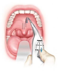 piller FIGURA 3: La procedura Pillar avviene grazie all'uso di una sonda monouso per l'inserimento dei bastoncini ad irrigidimento del palato.
