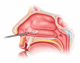 Snoring Laser Surgery