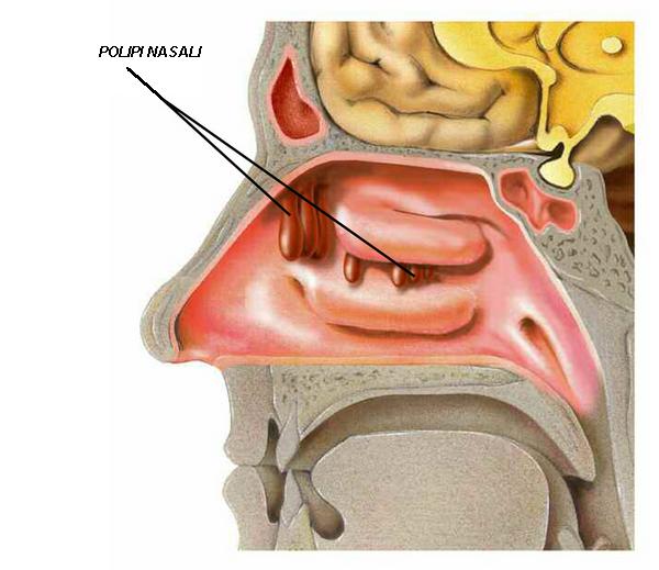 Nasal Polyps Laser Surgery