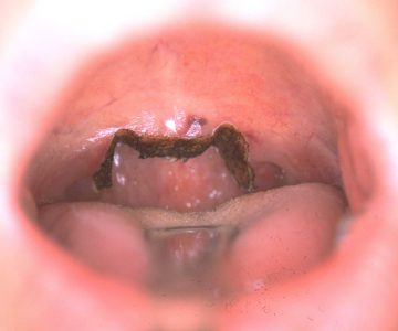 Figura 6: Risultato immediato di palatoplastica laser assistita (LAUP).