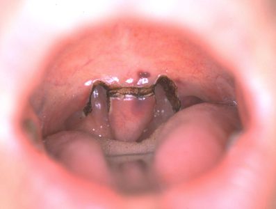 Figura 5: Riduzione laser dell’ugola.