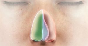 deviazione-setto-nasale